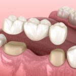 dental bridges, dental crowns