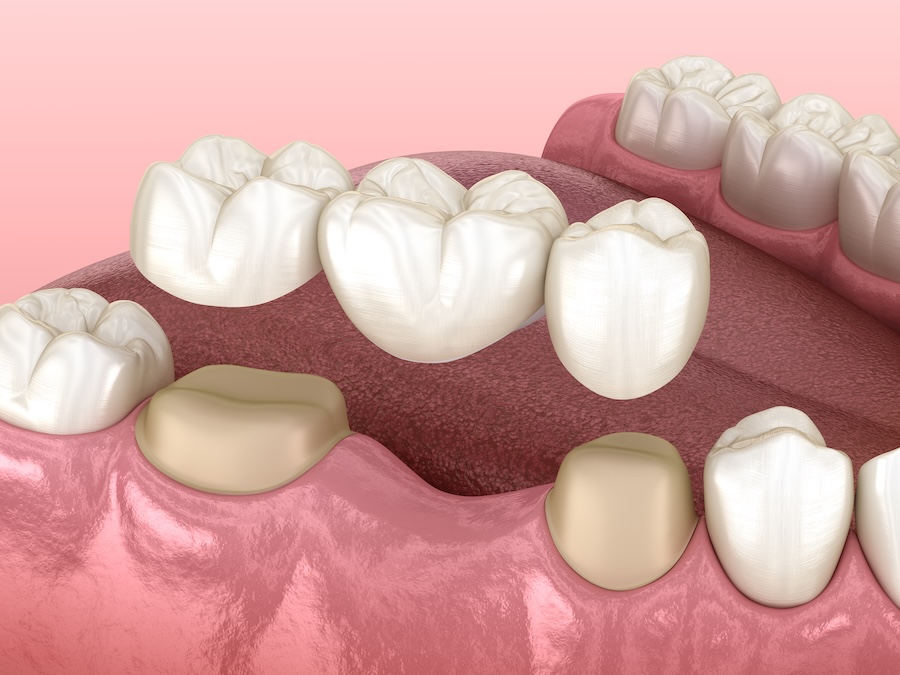 dental bridges, dental crowns